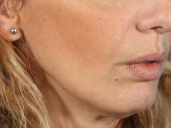Radiesse filler for jowls and nasolabial folds (liquid facelift) after 936993