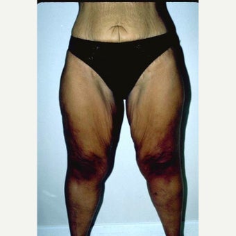 35-44 year old woman treated with Thigh Lift before 2490731
