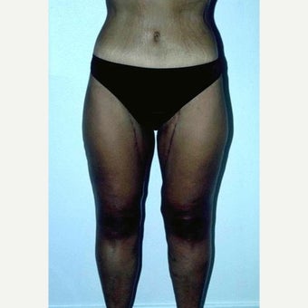 35-44 year old woman treated with Thigh Lift after 2490731