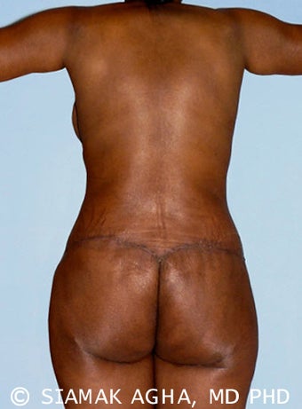 Body Lift 216793