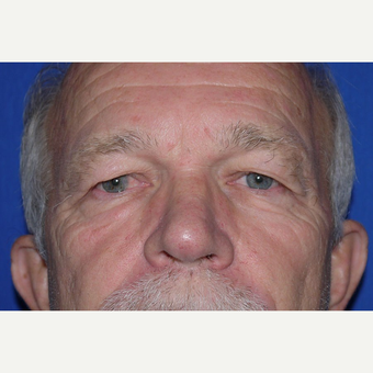 Eyelid Surgery before 3744043