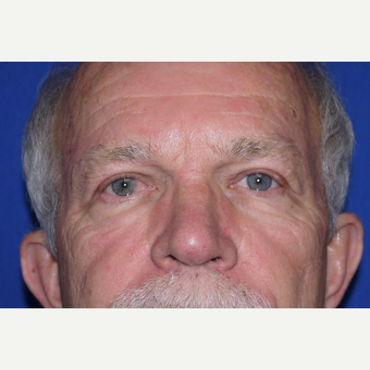 Eyelid Surgery after 3744043