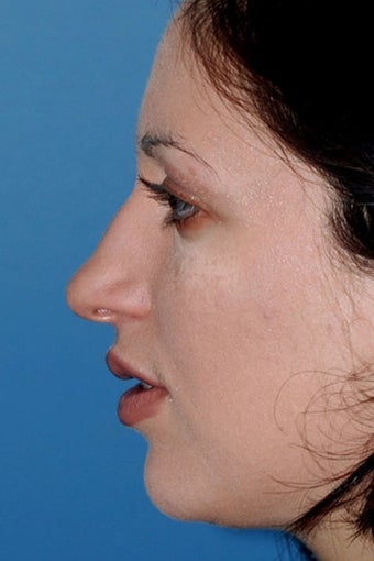 Rhinoplasty before 81102