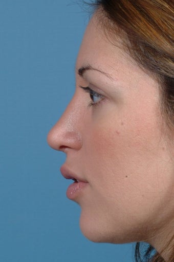 Rhinoplasty after 81102