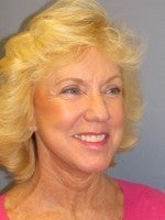 55-64 year old woman treated with Neck Lift after 3103947