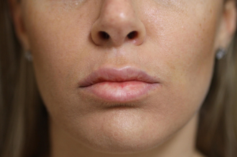25-34 year old woman treated with Lip Lift after 3548365