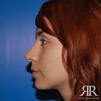 Rhinoplasty after 1315584