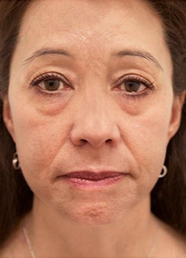 45 year old woman treated with lower blepharoplasty with fat removal before 2870046