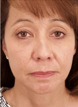 45 year old woman treated with lower blepharoplasty with fat removal after 2870046