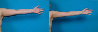 22-year-old woman treated with Liposuction. after 3287400