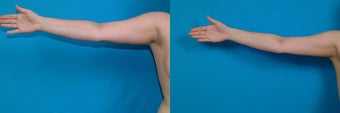 22-year-old woman treated with Liposuction. before 3287400