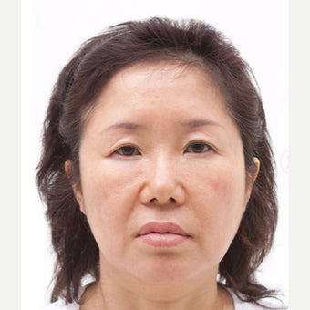 45-54 year old woman treated with SMAS Facelift/eyelid surgery/nasolabial folds surgery. before 2030765