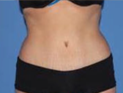 Full abdominoplasty (tummy tuck) with Jetstream Liposuction to love handles and lower back after 3381731
