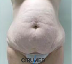 Full abdominoplasty (tummy tuck) with Jetstream Liposuction to love handles and lower back before 3381731