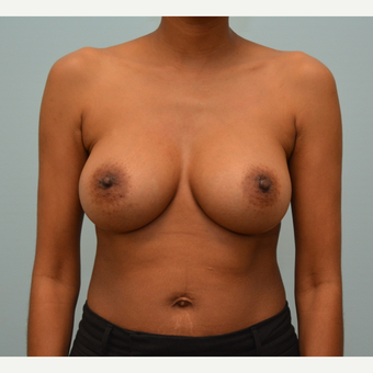 Breast Augmentation with Natrelle 410 Anatomically Shaped Implants after 2988519