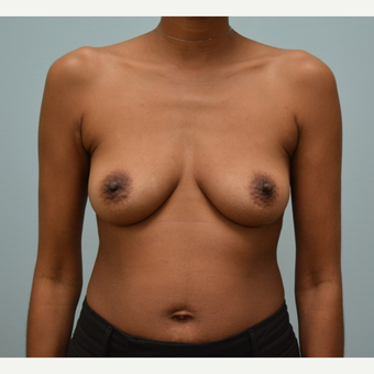 Breast Augmentation with Natrelle 410 Anatomically Shaped Implants before 2988519