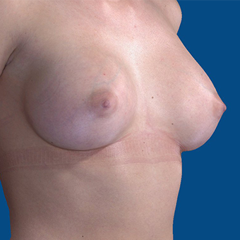 25-34 year old woman treated with Breast Augmentation after 3732377