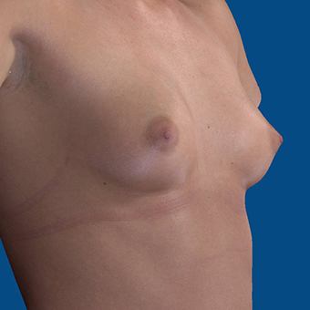 25-34 year old woman treated with Breast Augmentation before 3732377