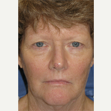 55-64 year old woman treated with Mohs Surgery after 3389152