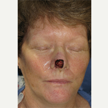 55-64 year old woman treated with Mohs Surgery before 3389152