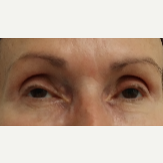 65-74 year old woman treated with Restylane for her tear troughs after 3412133
