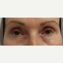 65-74 year old woman treated with Restylane for her tear troughs before 3412133
