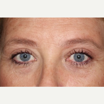 55-64 year old woman treated with Eyelid Surgery after 3170602