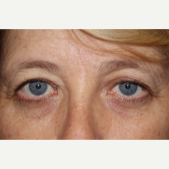 55-64 year old woman treated with Eyelid Surgery before 3170602