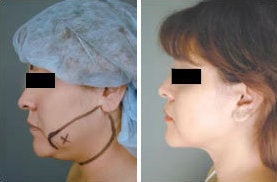 Chin Liposuction before 349910