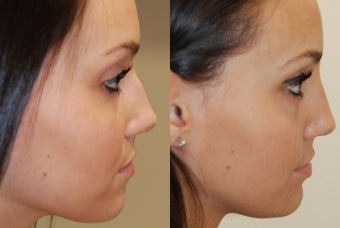 Non-Surgical Rhinoplasty with Silikon-1000. 3 treatments before 388359