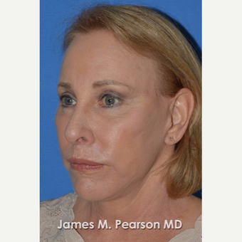 55-64 year old woman treated with Facelift after 3802251