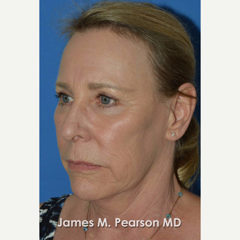 55-64 year old woman treated with Facelift before 3802251