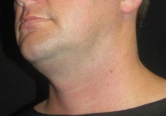 33 year old man treated with NeckTite RFAL before 3683543