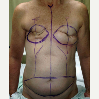 Breast Reconstruction Revision with DIEP flaps for this 52 Year Old Woman before 3005394