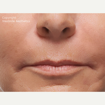 Radiesse Nasolabial Folds after 2972689