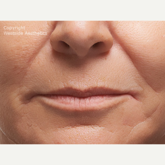 Radiesse Nasolabial Folds before 2972689
