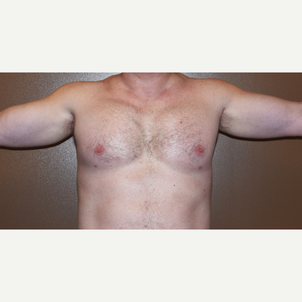 45-54 year old man treated with Custom Pectoral and Bicep Implants after 3407832
