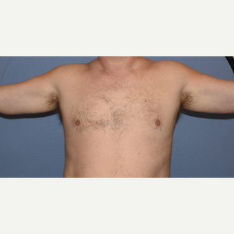 45-54 year old man treated with Custom Pectoral and Bicep Implants before 3407832