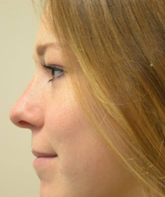 18-24 year old woman treated with Rhinoplasty after 2764828