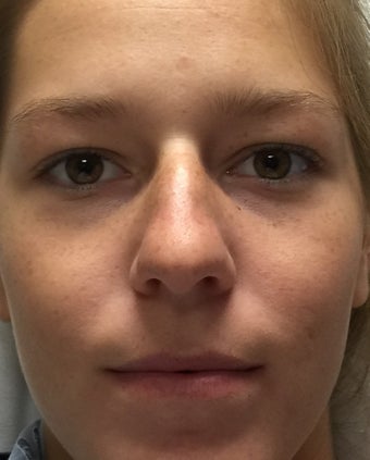 18-24 year old woman treated with Rhinoplasty 2764828