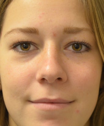18-24 year old woman treated with Rhinoplasty 2764828