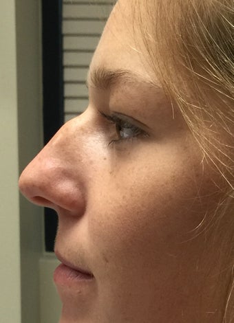 18-24 year old woman treated with Rhinoplasty before 2764828