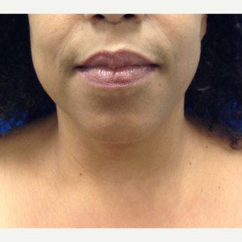 35-44 year old woman treated with Chin Liposuction after 2703749