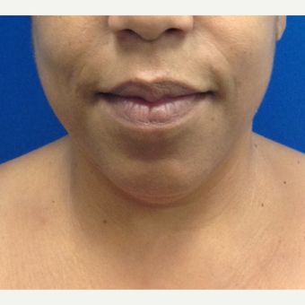 35-44 year old woman treated with Chin Liposuction before 2703749