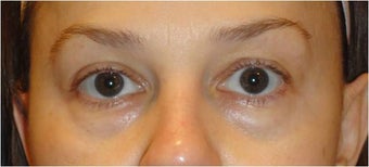 Restylane before 686385