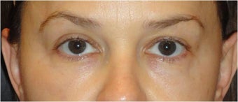 Restylane after 686385