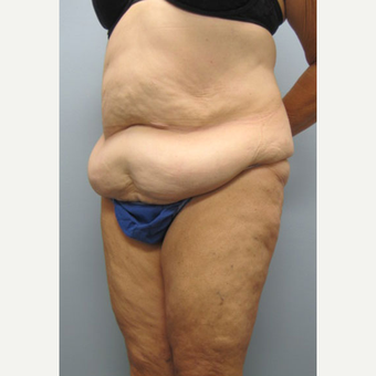 57 year old woman treated with Tummy Tuck before 3680153