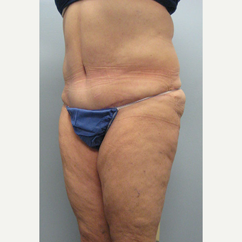 57 year old woman treated with Tummy Tuck after 3680153