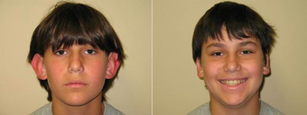 Ear Surgery before 1012848