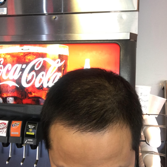 25-34 year old man treated with Hair Loss Treatment after 3618765